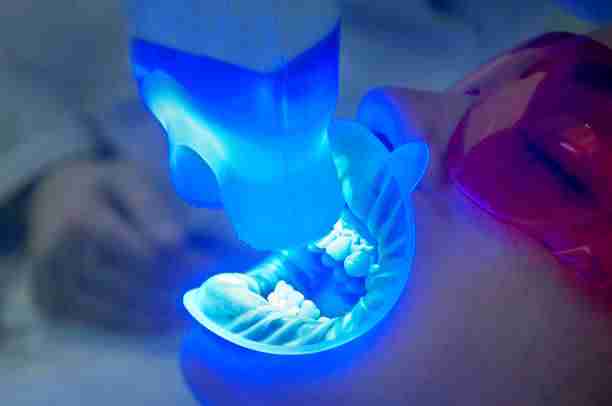 Pearly Whites: Teeth Whitening Experiences in Riyadh