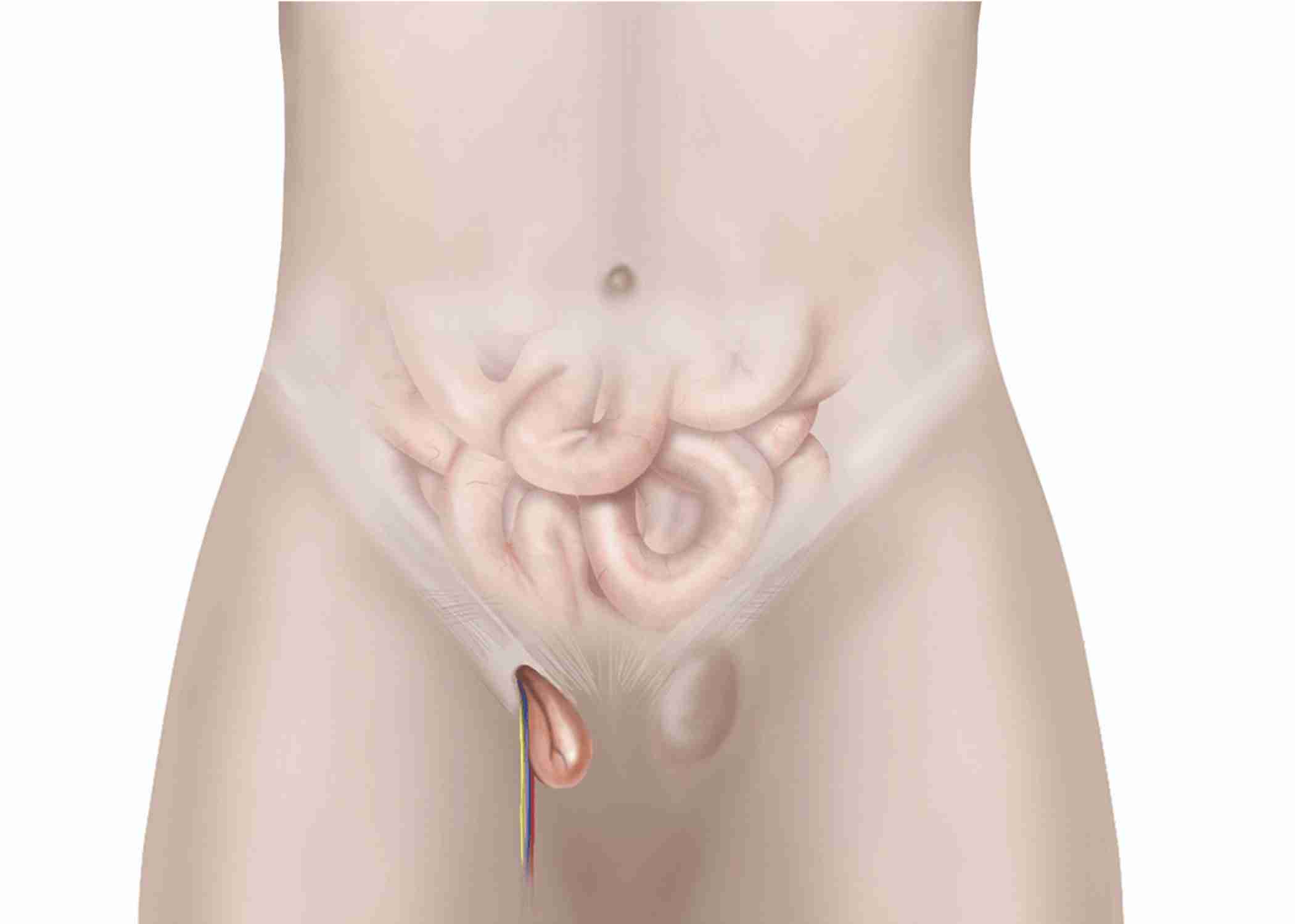 Best Inguinal Hernia Treatment in Guwahati: Expert Solutions for Effective Relief