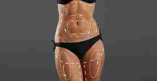 Precision Sculpting Riyadh’s Liposuction Artistry Unveiled