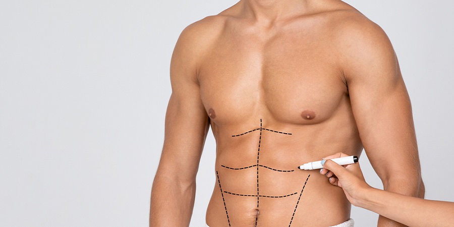 Achieving Six-Pack Abs Riyadh’s Surgical Expertise