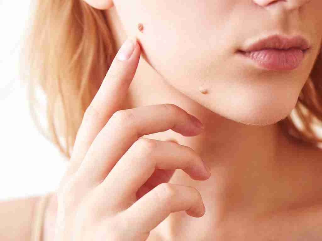 From Spots to Smoothness Skin Lesion Removal in Riyadh