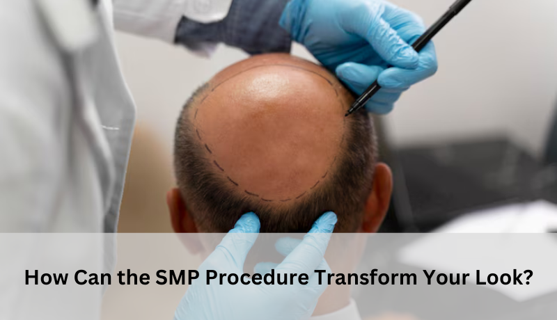 How Can the SMP Procedure Transform Your Look?