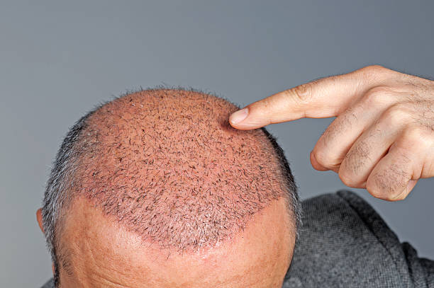 The Cost of Hair Transplants in Abu Dhabi