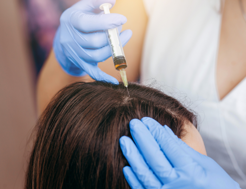 Understanding the Plasma Hair Injection Process in Abu Dhabi