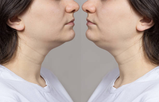 Choosing the Right Clinic for Chin Liposuction in Abu Dhabi