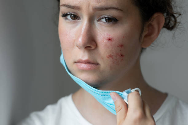 Laser Treatments for Acne in Abu Dhabi