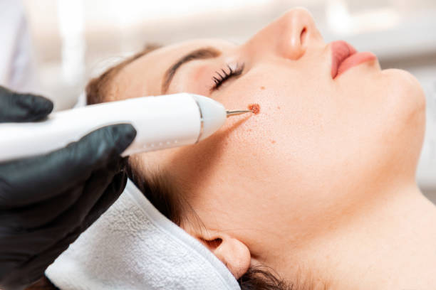Safe and Reliable Skin Warts Treatments in Abu Dhabi