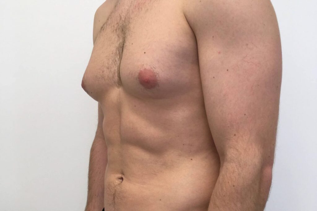 The Role of Hormones in Gynecomastia: Insights for Men in Dubai