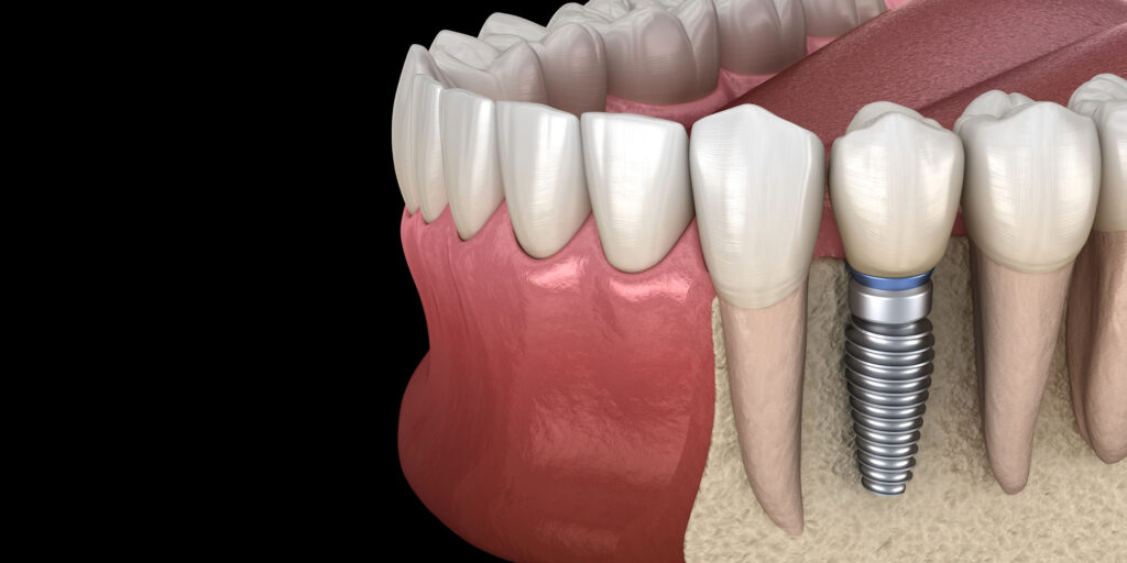 Dental Implants vs. Traditional Dentures in New Jersey: Which is the Better Option for You?