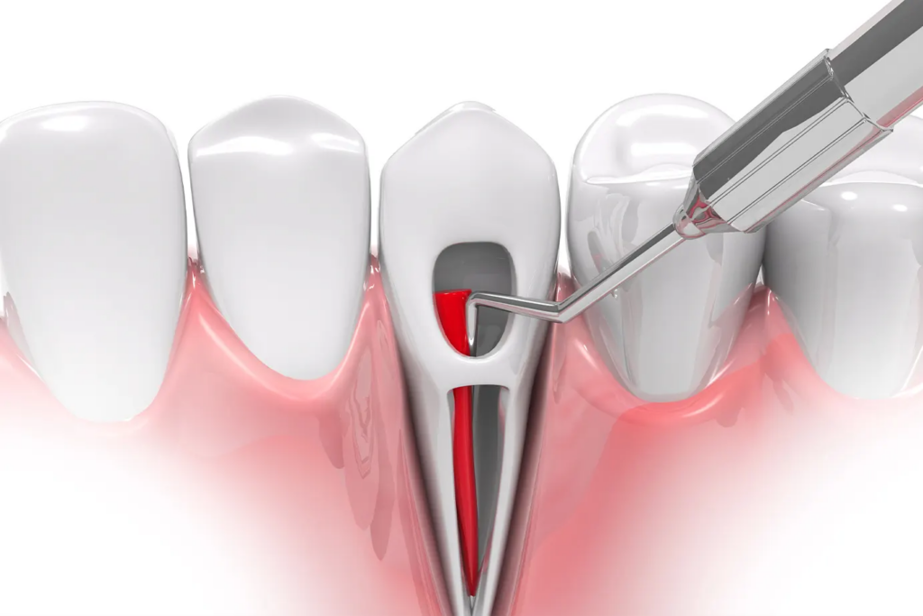 Debunking Common Misconceptions About Root Canal Therapy