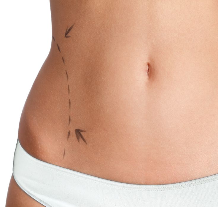 4D Vaser Liposuction in Riyadh: For a Sculpted and Defined Look