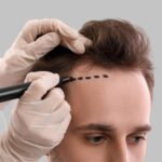 Before and After Hair Transplant: Real Transformations