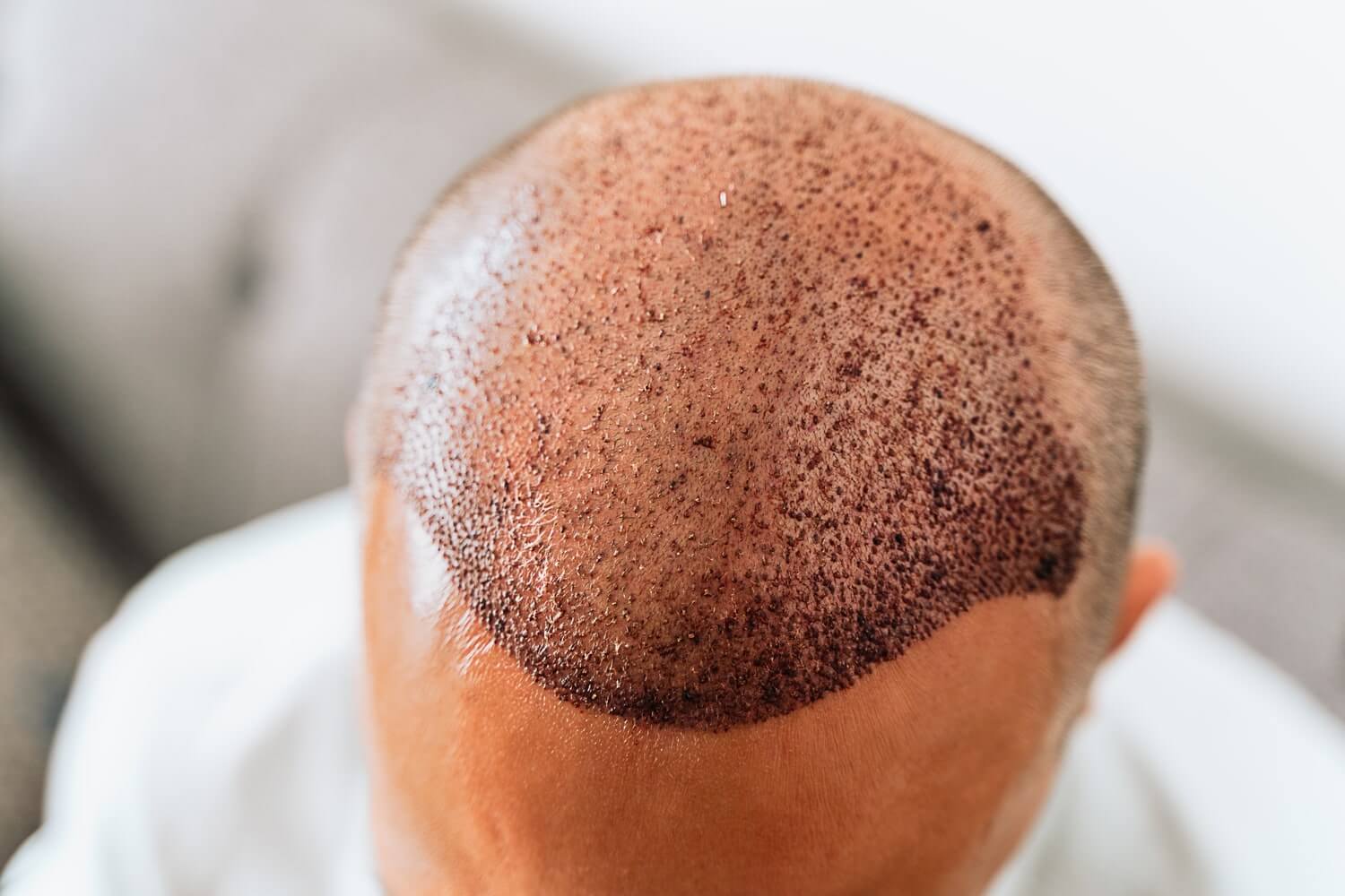 Hair Transplant For Men Dubai