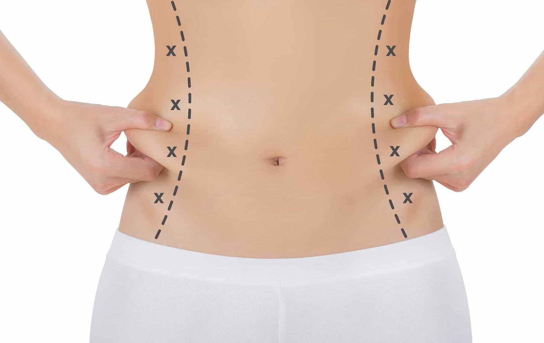 Sculpt Your Dream Figure with Body Jet Liposuction Today