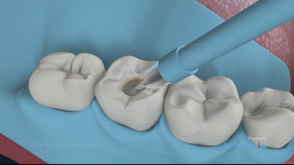 Signs You Might Need a Tooth Filling and When to See a Dentist