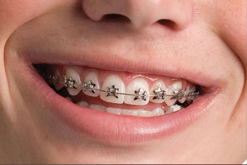 Braces Costs in Dubai: How to Choose the Right Option for Your Budget
