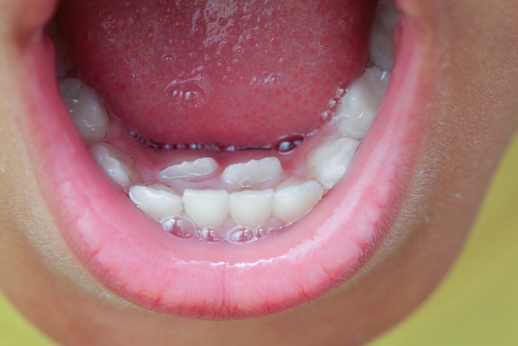 The Benefits of Treating Overlapping Teeth and How to Get Started