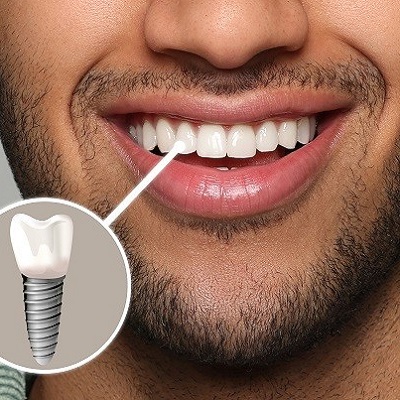 Regain Confidence with Durable Dental Implant Procedures
