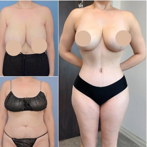 Best Tummy Tuck Surgeons in dubai: Combining Precision with Care