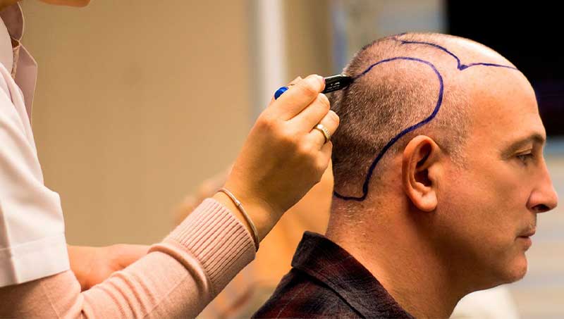 Hair Transplant in Dubai