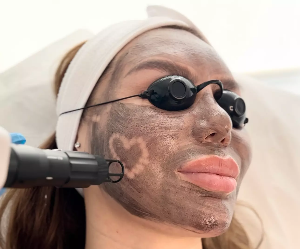 Laser Carbon Peel for a Brighter and More Even Skin Tone