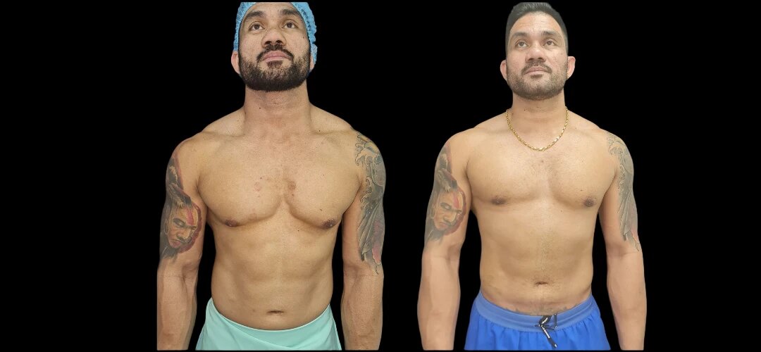 Affordable Gynecomastia Options in Dubai