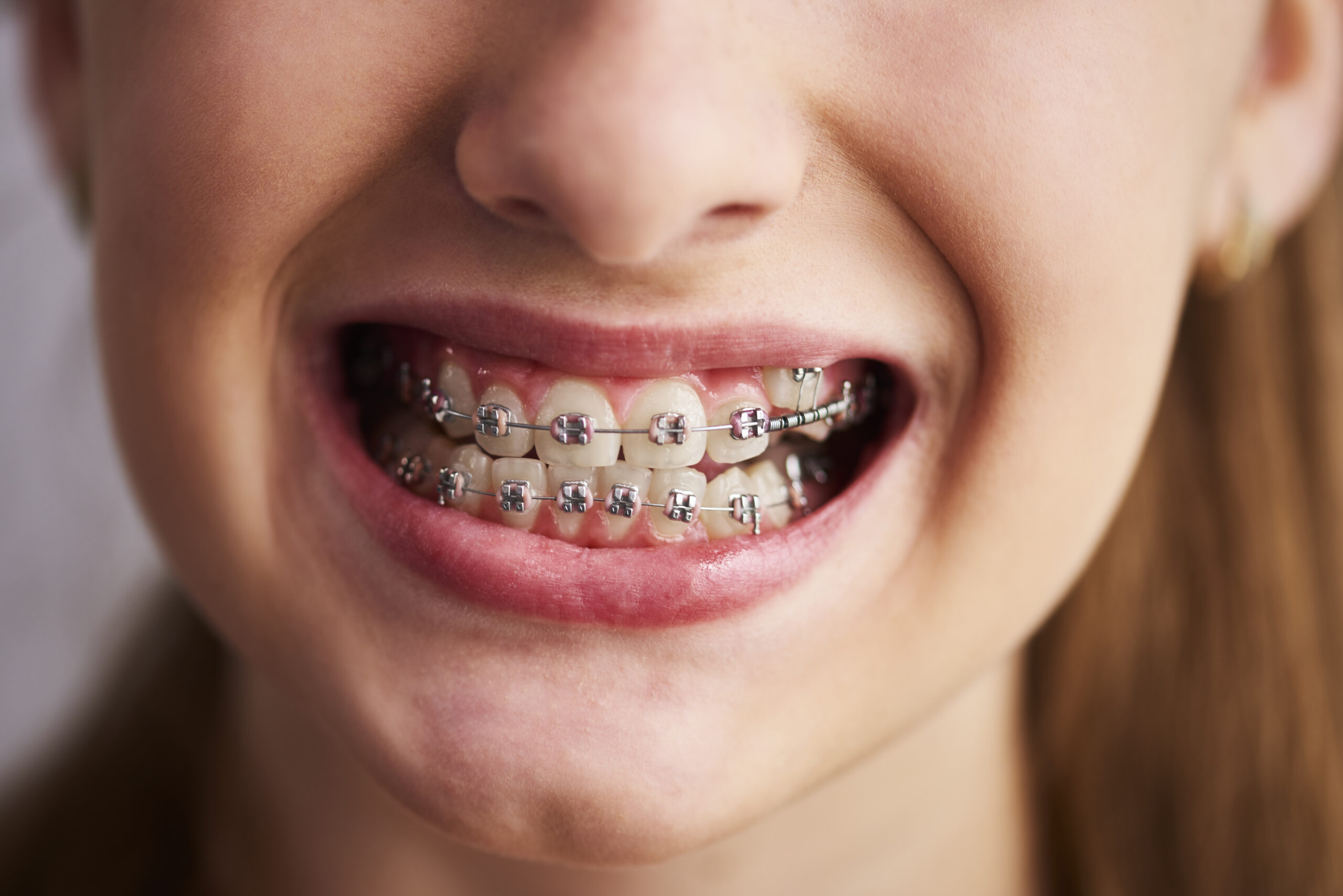 How Orthodontics in Lake Ridge Can Improve Your Confidence and Oral Health