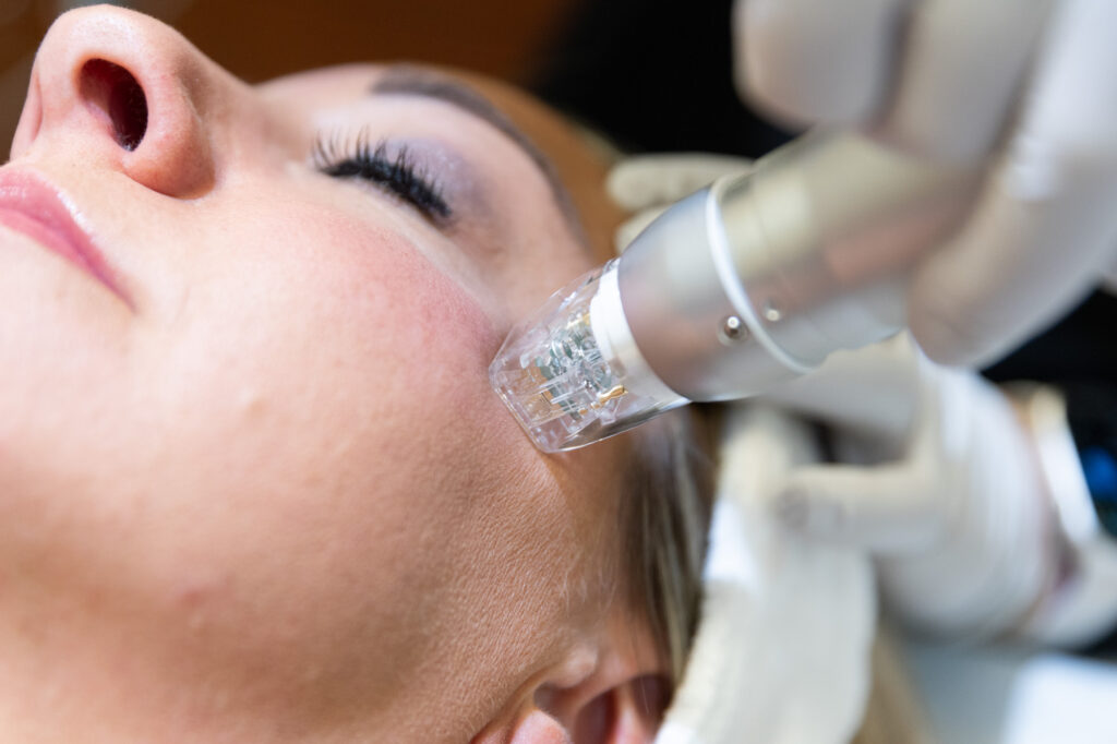 Acne Scar Laser Therapy for Flawless Skin