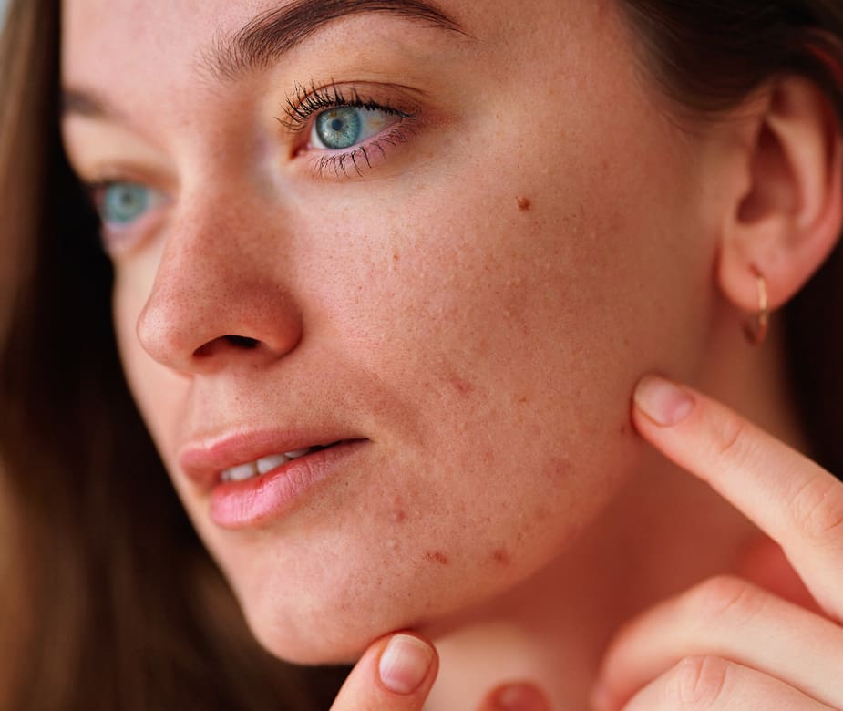 How to Maintain Acne-Free Skin After Treatment: A Long-Term Guide