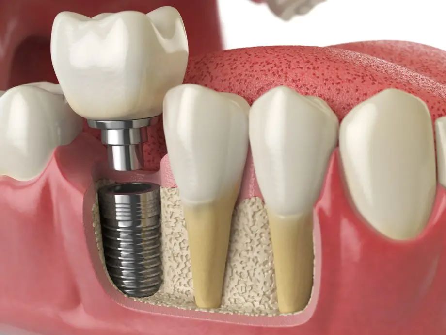Cheap Dental Implants in Caldwell, ID: Affordable Options for a Better Smile