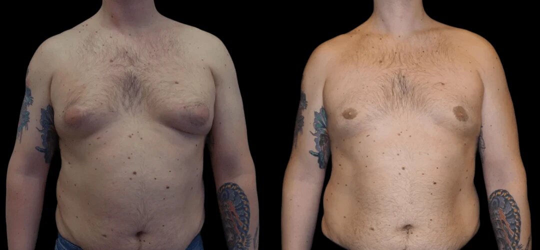 Gynecomastia Surgery in dubai: How Lifestyle Changes Can Help Reduce Symptoms