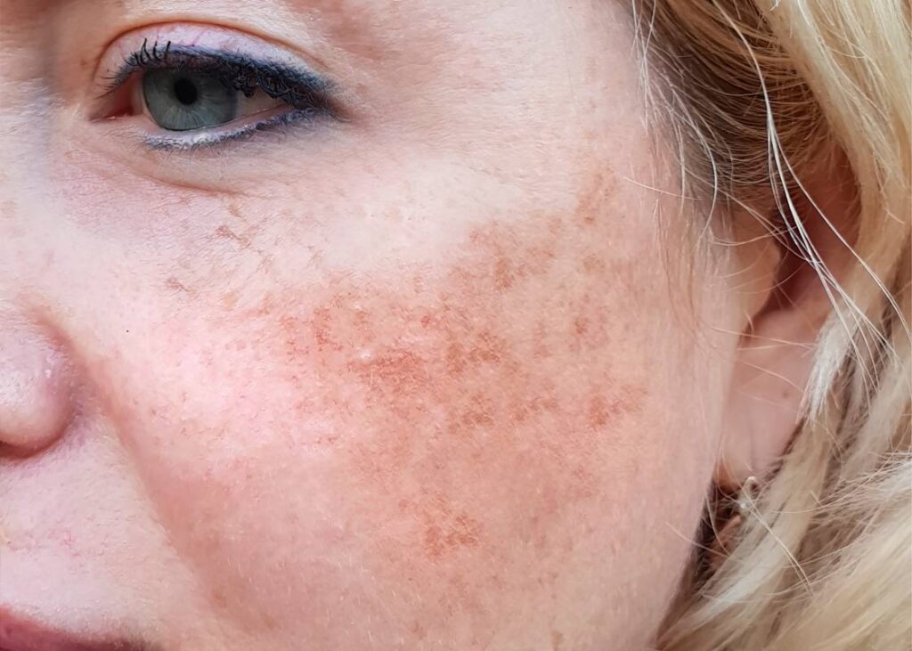 Microneedling for Melasma: Can Tiny Needles Give You Clear Skin?