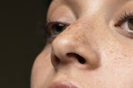 Melasma Treatment Guide: How to Achieve Even-Toned Skin