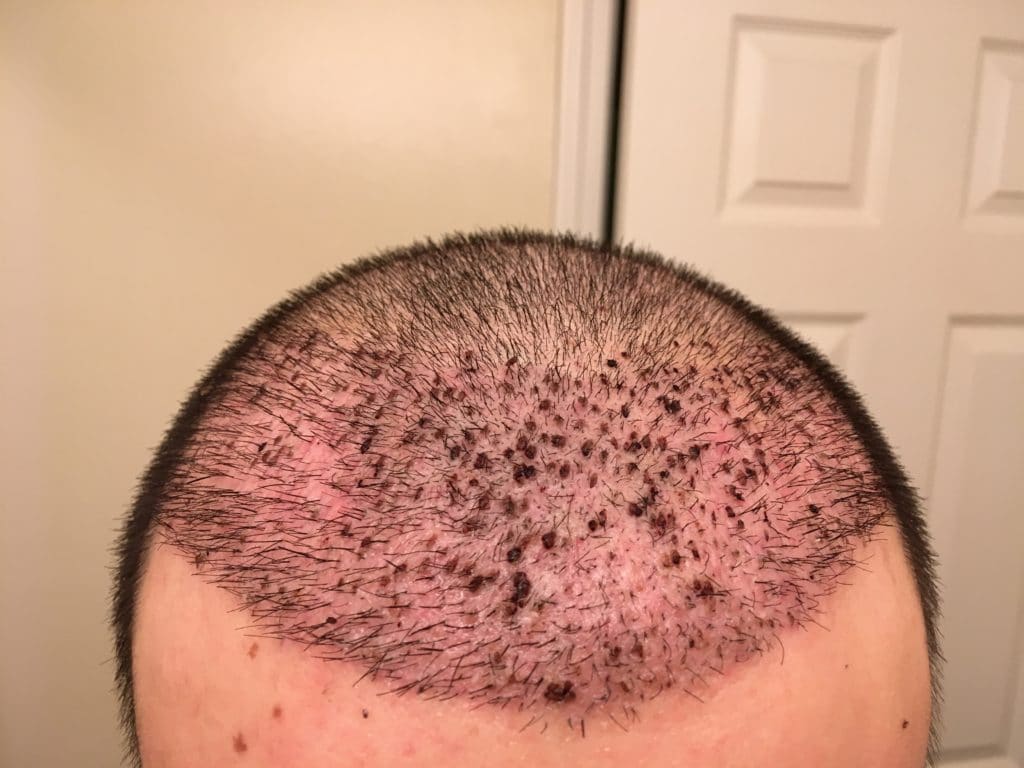 Safe and Effective FUT Hair Transplant