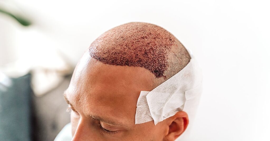 What Makes Crown Hair Transplant So Effective?