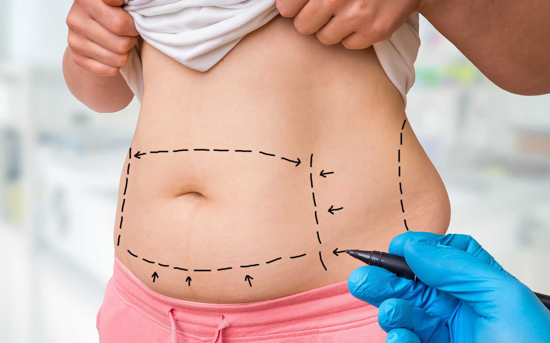 Why Liposuction Is a Game-Changer for Body Contouring?