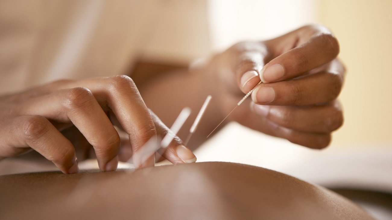 Improve Your Well-being with Expert Acupuncturists in Chennai