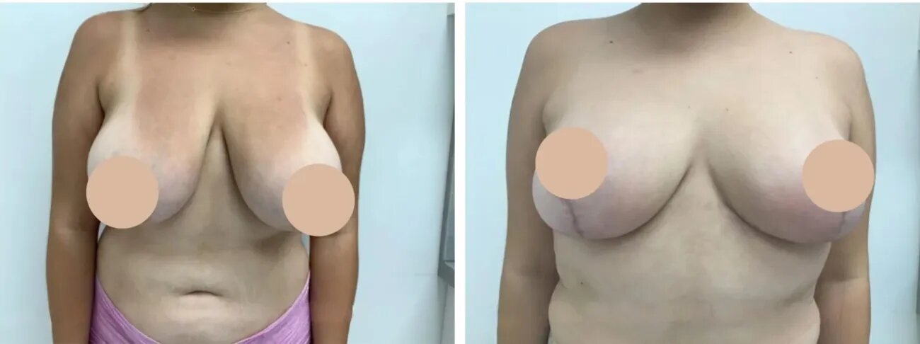 How a Breast Lift Surgery in dubai Can Restore Confidence and Enhance Your Body Shape