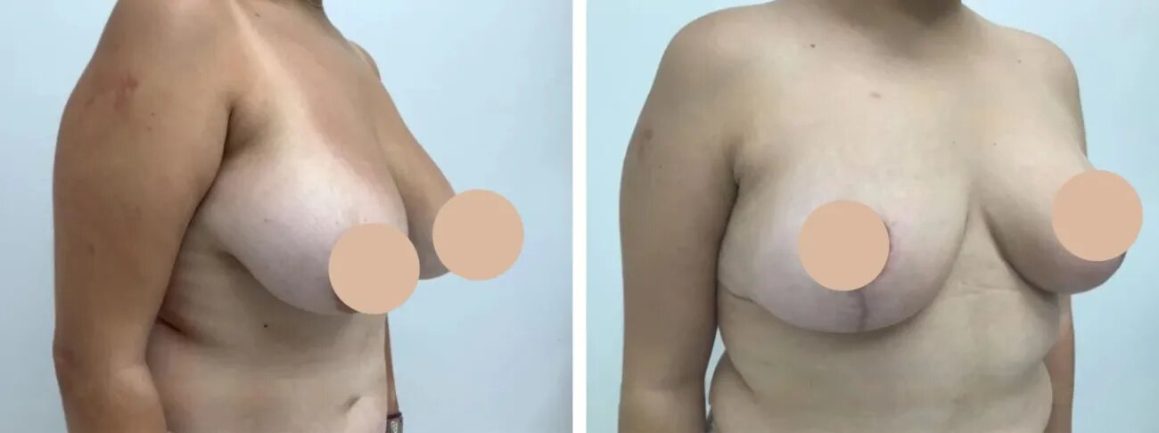 How to Reduce Scarring After Breast Reduction Surgery in dubai