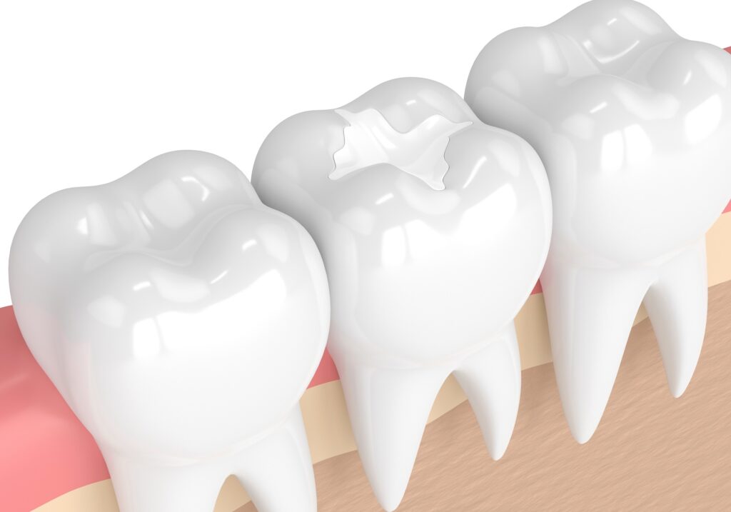 Restorative Dentistry and Tooth Fillings: What You Need to Know