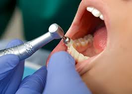 Why Dental Cleanings in Boise, Idaho Are Important for Your Health?