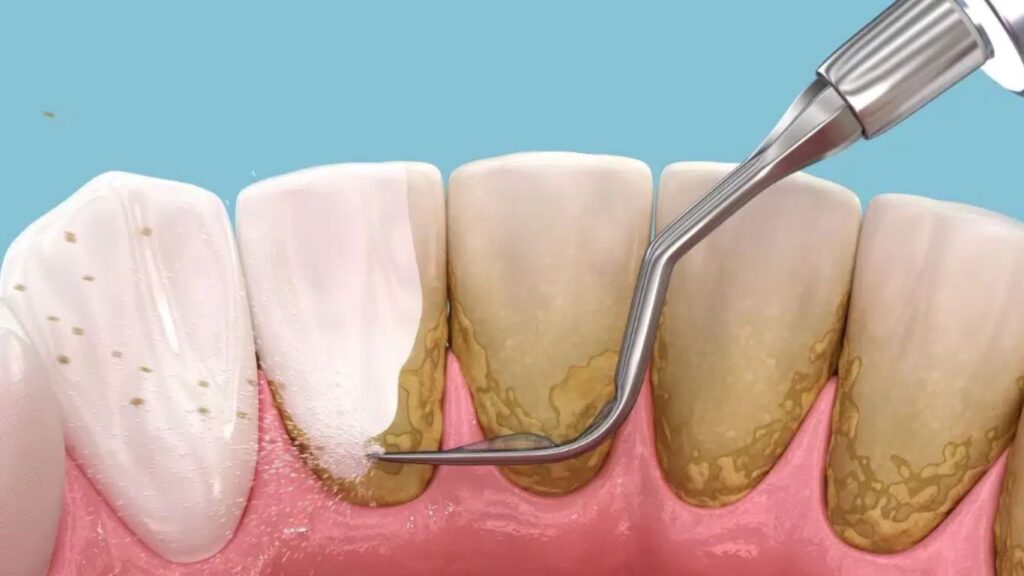 The Importance of Preventive Dentistry and Dentist Deep Cleaning