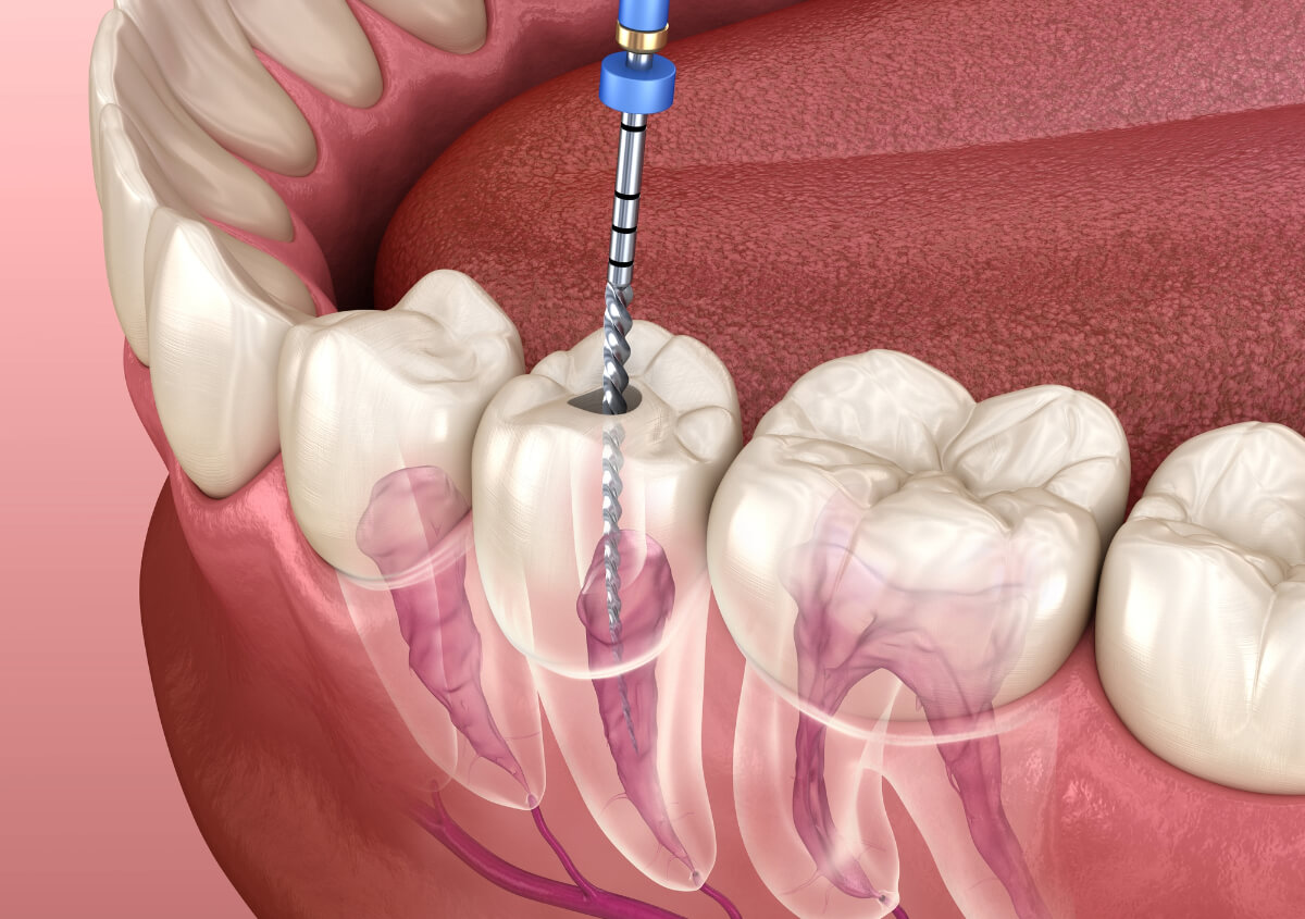 Understanding Endodontic Therapy: Procedures & Benefits