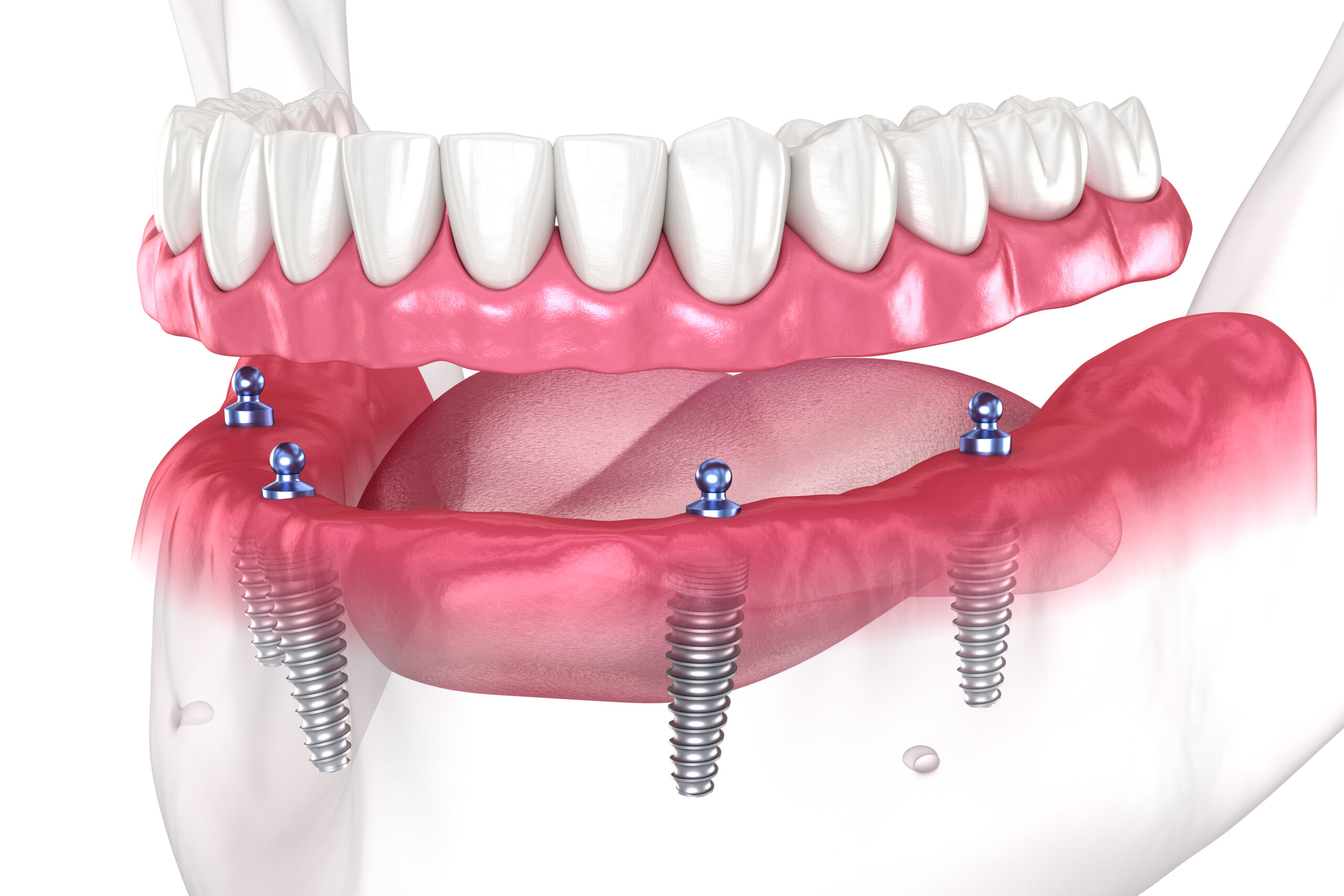 Full Mouth Dental Implants & Crowns on Front Teeth: A Perfect Smile Solution