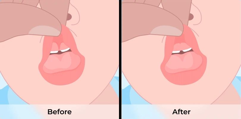 Lip Tie in Billings, Montana: What You Need to Know About Treatment?