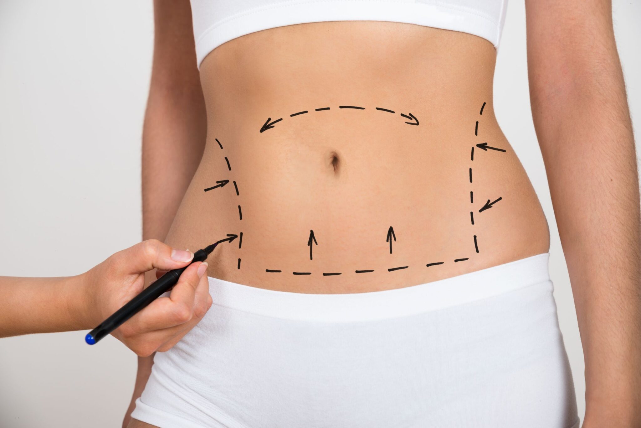 Arm & Back Liposuction in Riyadh: Say Goodbye to Fat Deposits