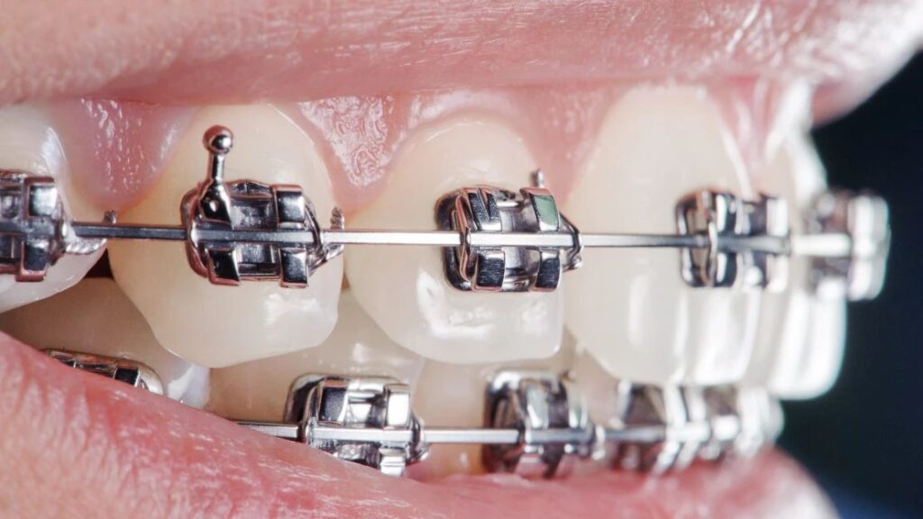 Affordable Adult Orthodontics in Nampa, ID: A Guide to a Confident Smile