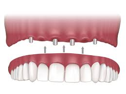 Permanent Denture Implants in Nampa, ID: A Long-Lasting Solution for Missing Teeth