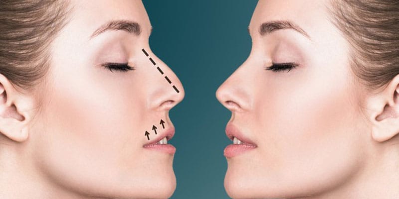 5 خطوات لضمان نجاح تجميل الأنف في الرياض