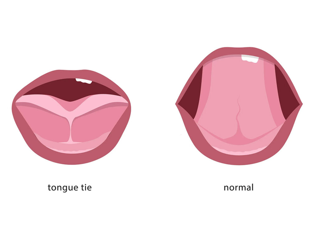 New and Quick Solutions for Lip Tie and Upper Lip Tie in Laurel, Montana
